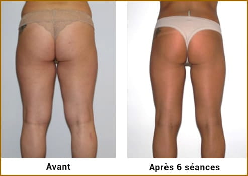 Avant Après LPG Cellu M6 Alliance