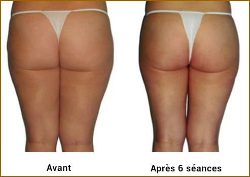 Avant Après LPG Cellu M6 Alliance