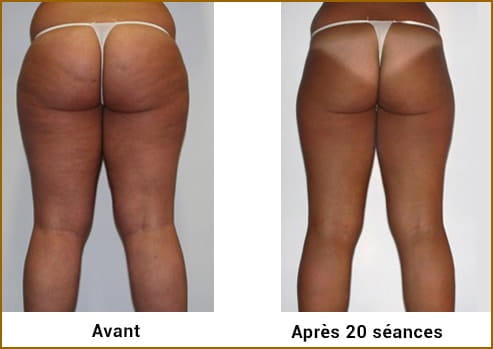 Avant Après LPG Cellu M6 Alliance