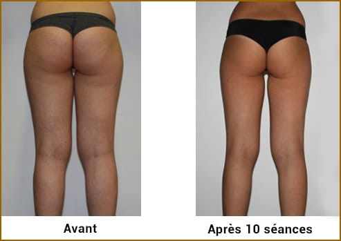 Avant Après LPG Cellu M6 Alliance