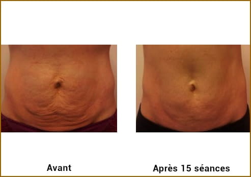 Avant Après LPG Cellu M6 Alliance