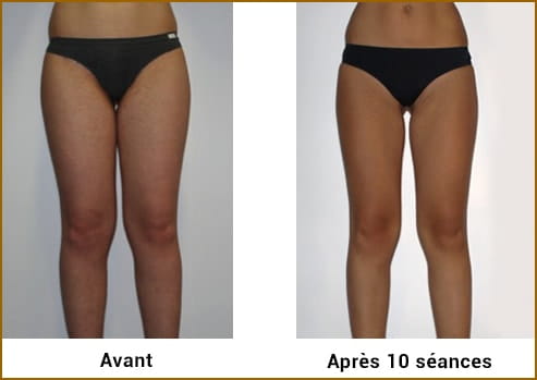 Avant Après LPG Cellu M6 Alliance